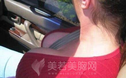 假体丰胸外观设计和手感是否会很假?