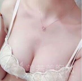 韩式微创丰胸手术术后一个月