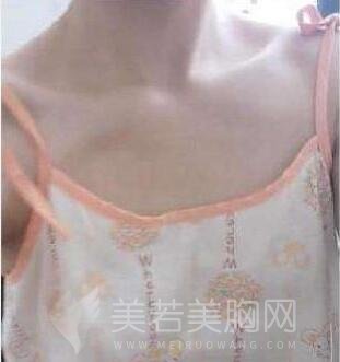 程晓琳医生假体隆胸手术术前
