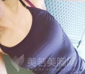 程晓琳医生假体隆胸手术术后两个月