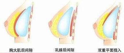 娜高假体丰胸手术恢复期是多长时间?