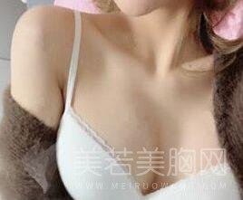 假体丰胸手术案例