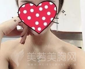 上海韩镜医疗美容医院做隆胸好吗?案例图及价格信息