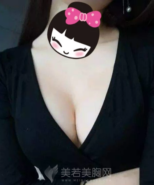 娜高假体隆胸术后的果,轻松做到“以假乱真”