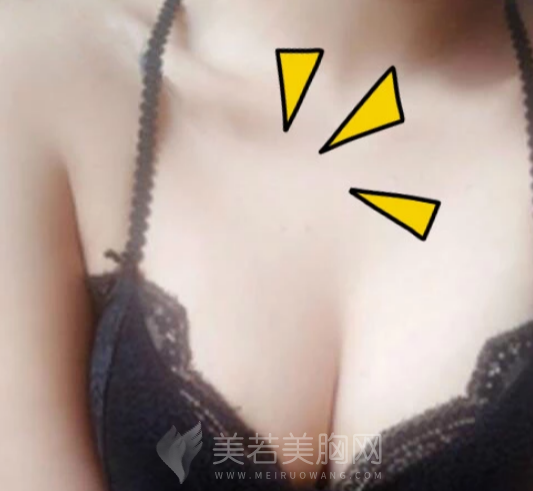 娜高假体隆胸术后的果,轻松做到“以假乱真”