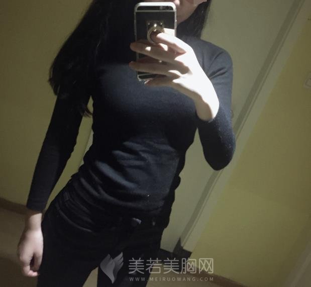 自体脂肪隆胸果自然吗?说实话比假体看着真实多了!