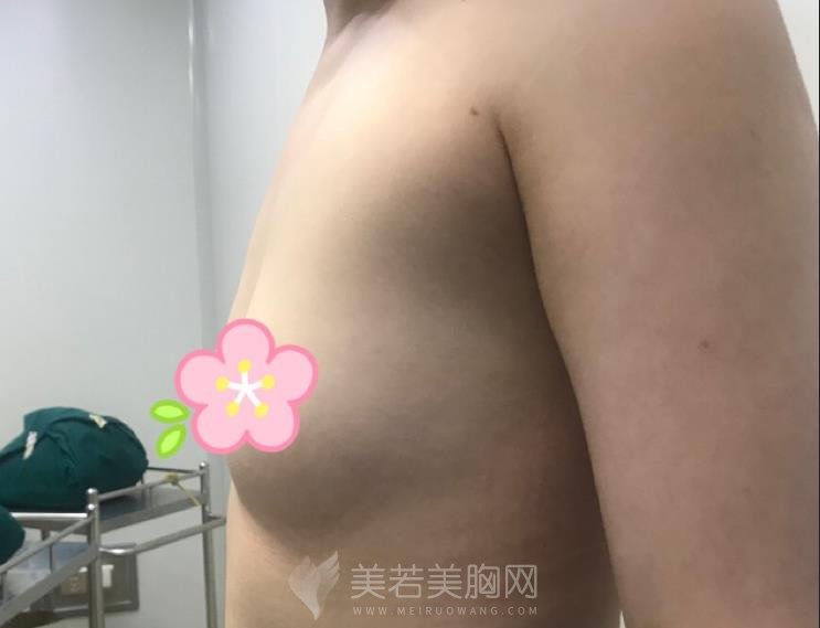 美莱脂肪隆胸技术:脂肪大挪移,哪里凹陷填哪里