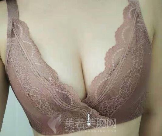 美莱脂肪隆胸技术:脂肪大挪移,哪里凹陷填哪里