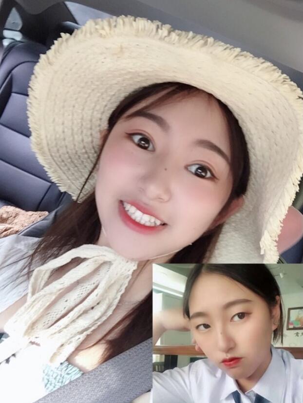 杭州维多利亚做的双眼皮