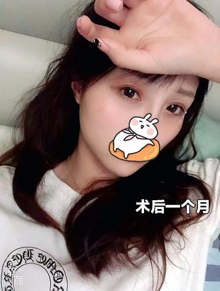 佛山华美整形医院双眼皮案例