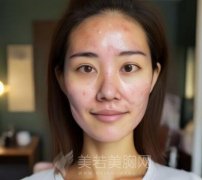 痤疮治疗需要多少钱？费用因素有哪些