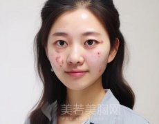 激光祛痘副作用是什么？一键了解相关的介绍
